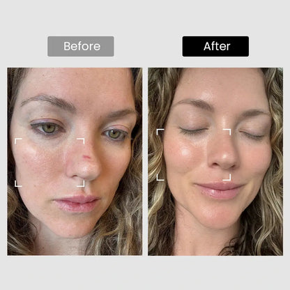 Derm Rays Revive 1064nm Skincare Laser Device