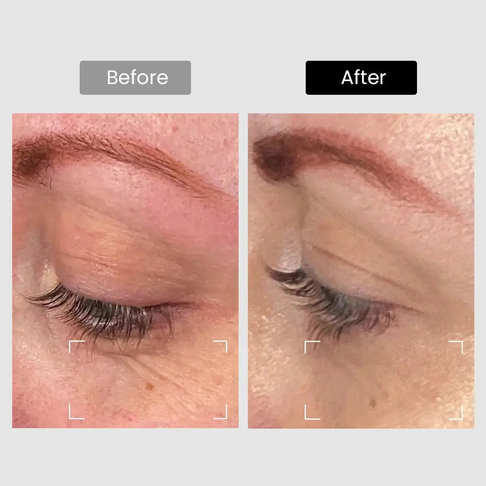 Derm Rays Revive 1064nm Skincare Laser Device