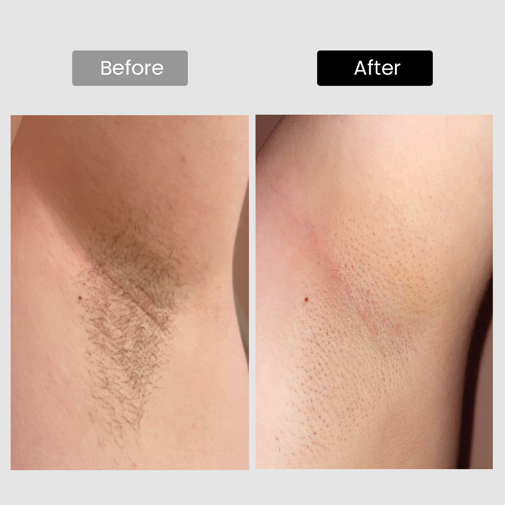 Derm Rays V8S Enhanced Edition Diode Laser Hair Removal Device