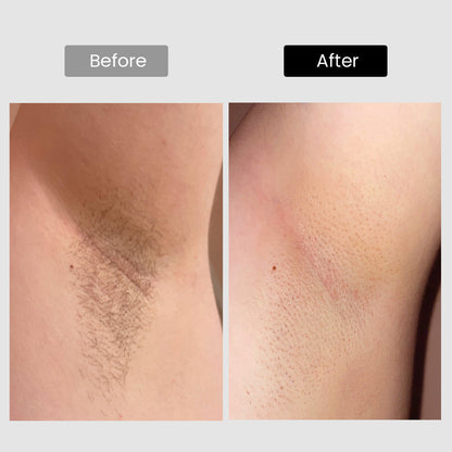 Derm Rays V8S Enhanced Edition Diode Laser Hair Removal Device