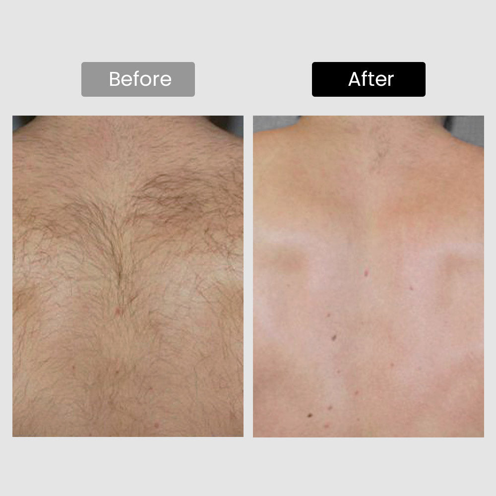 Derm Rays V8S Enhanced Edition Diode Laser Hair Removal Device