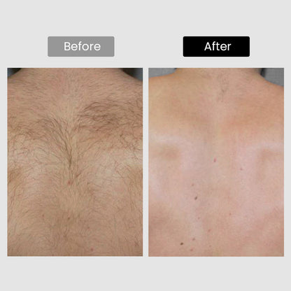 Derm Rays V8S Enhanced Edition Diode Laser Hair Removal Device
