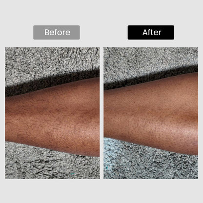 Derm Rays V6S 1064nm Diode Laser Hair Removal Device for Darker Skin Tones