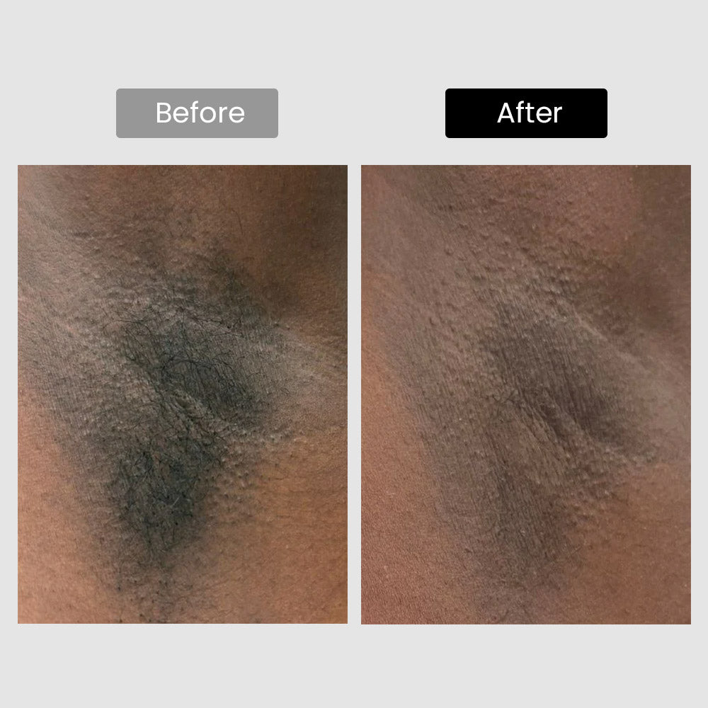Derm Rays V6S 1064nm Diode Laser Hair Removal Device for Darker Skin Tones