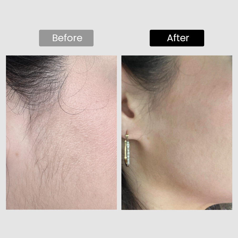 Derm Rays V8S 810nm Diode Laser Hair Removal Device