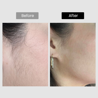 Derm Rays V8S 810nm Diode Laser Hair Removal Device