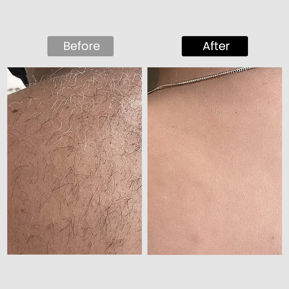 Derm Rays V8S 810nm Diode Laser Hair Removal Device