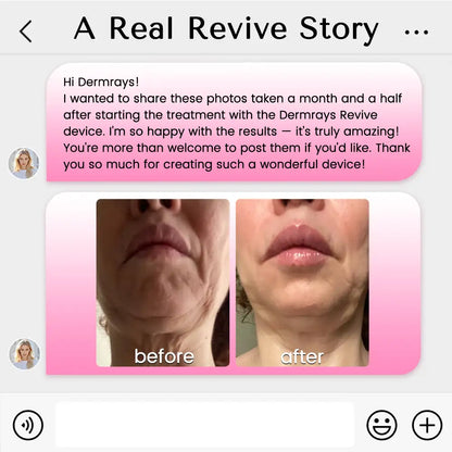 Derm Rays Revive 1064nm Skincare Laser Device